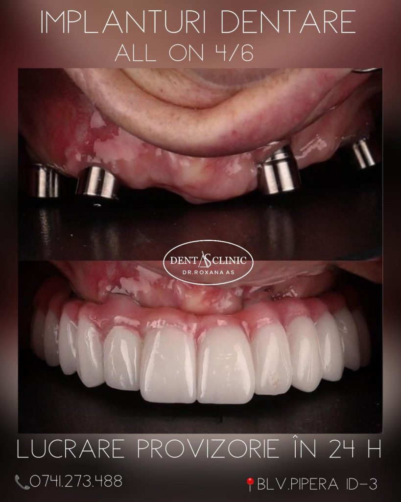 Implanturi dentare All-on-4 sau All-on-6 - lucrare provizorie în 24 de ore la Dentas Clinic