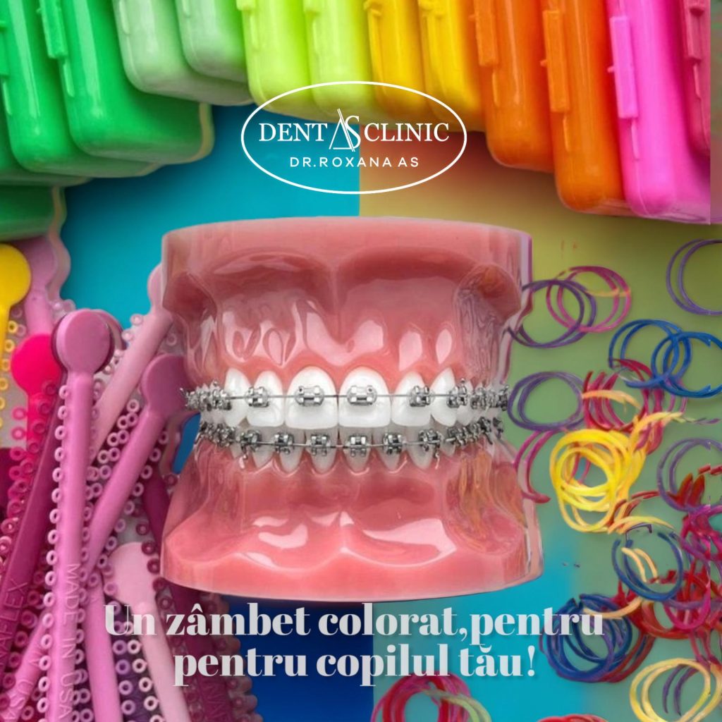 Aparat dentar colorat pentru copii - tratamente ortodontice la Dentas Clinic